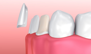 Veneers Can Fix - Stains, Gaps, Crooked Teeth