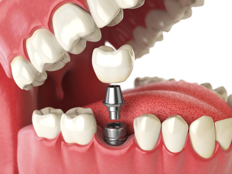 Navigating Dental Implant Options: Your Guide to Smiling
