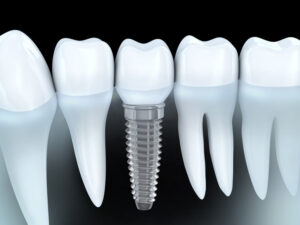 Dental Implants: The Cavity-Proof Teeth Replacement