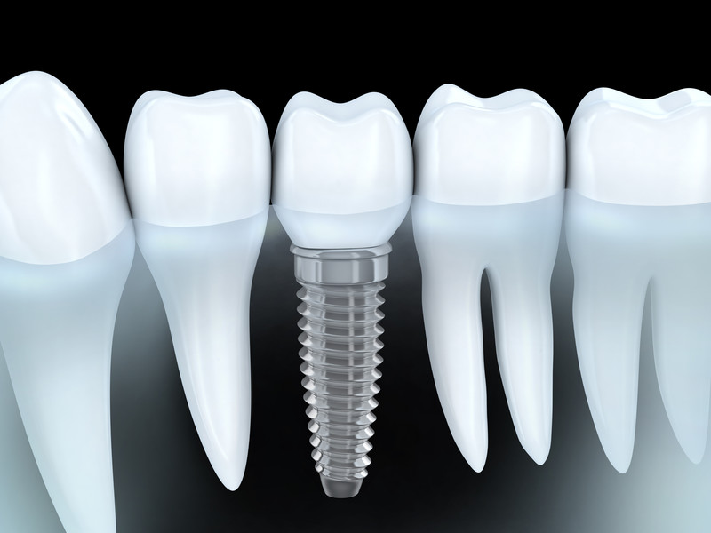 Dental Implants: The Cavity-Proof Teeth Replacement