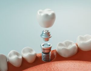 Dental Implants: Your Journey to a Restored Smile